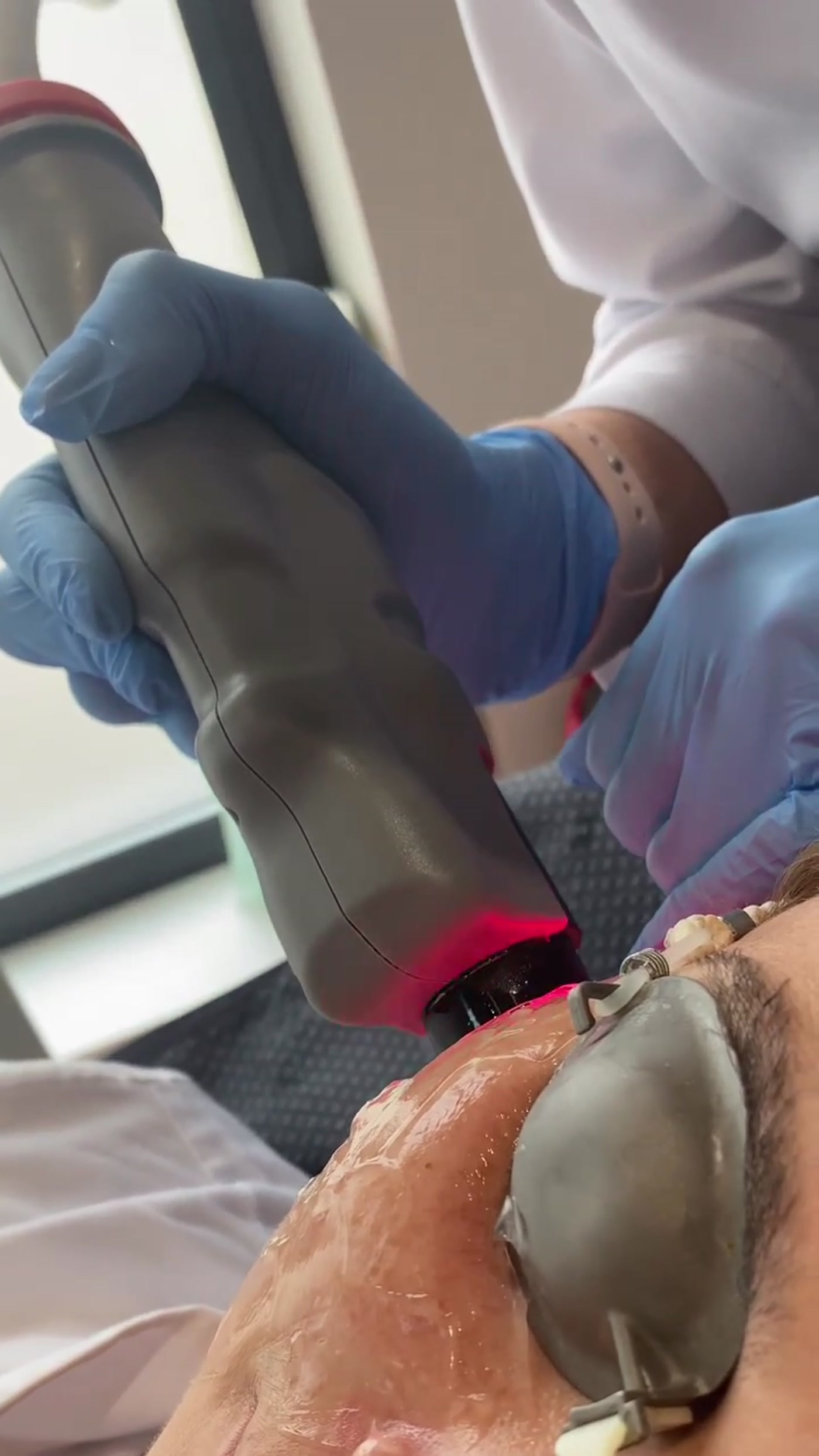 Depilacja laserowa Primelase w Endermology Center Suwałki
